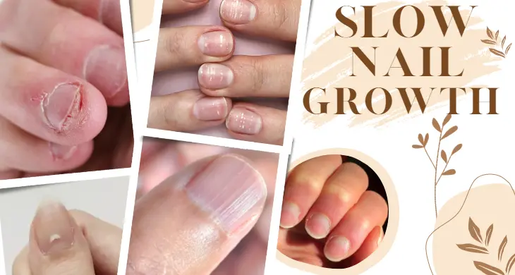 Common Causes of Slow Nail Growth