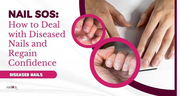 Deal with Diseased Nails and Regain Confidence