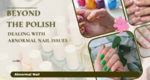 Dealing with Abnormal Nail Issues