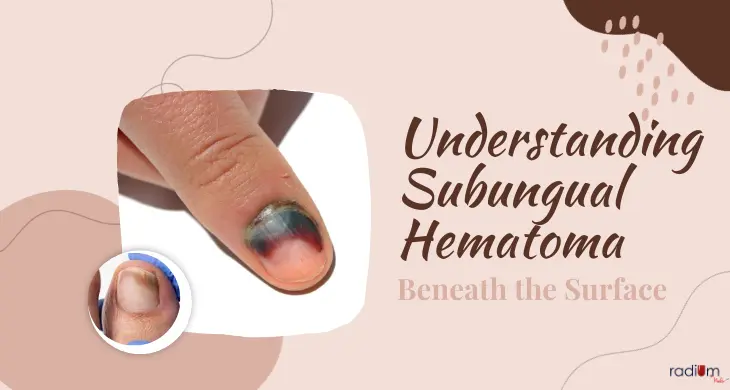 Beneath-the-surface-understanding-subungual-hematoma