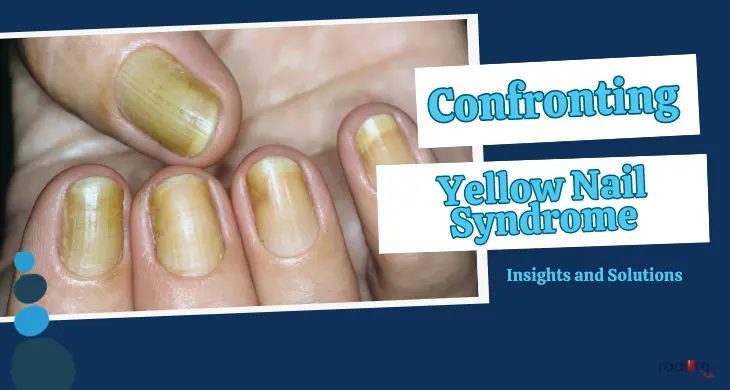 Yellow-nail-syndrome