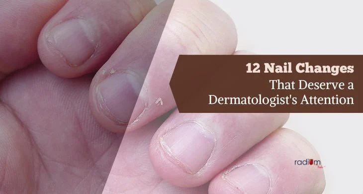 12 Nail Changes That Deserve a Dermatologist's Attention
